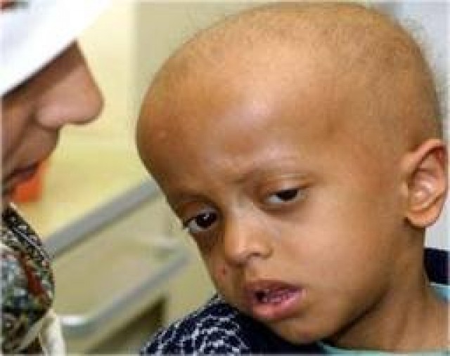 الحوثيون يقتلون عشرات الأطفال المصابين بالسرطان